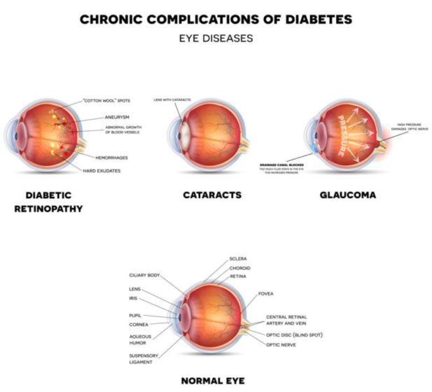 Diabetic Eye Diseases. Diabetic retinopathy cataract and glaucoma. At the bottom line healthy eye detailed anatomy.