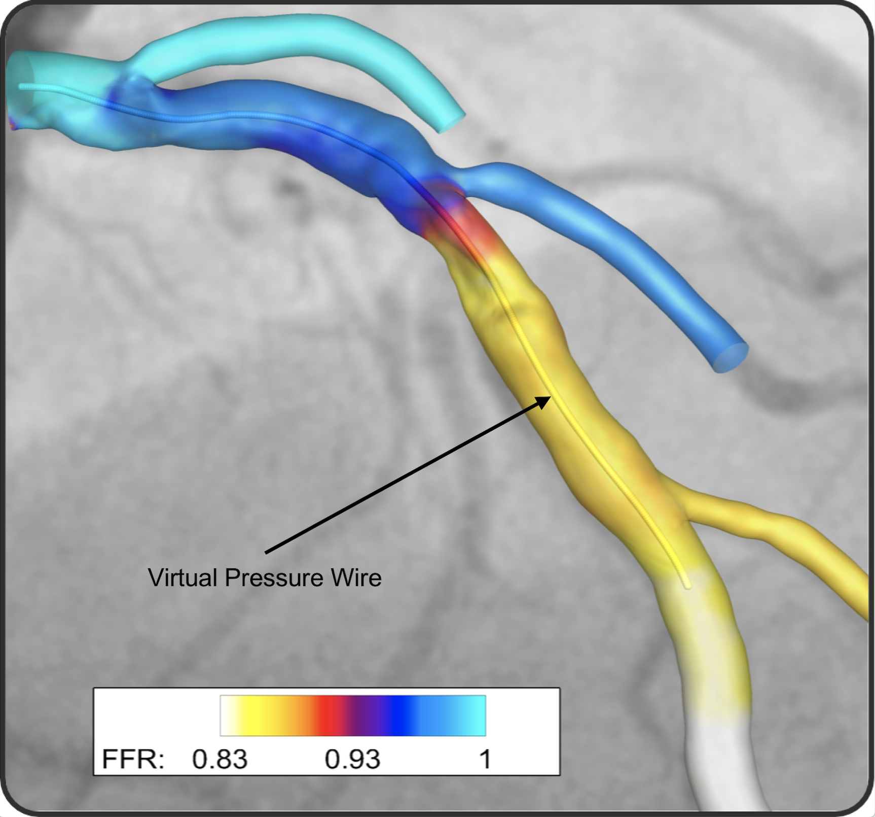 Computer reconstruction of an artery